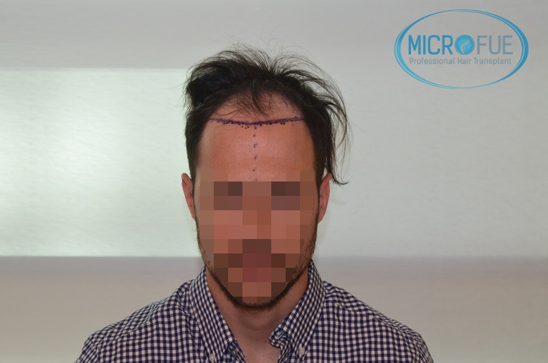 Evolución de trasplante de pelo en entradas Evolución de trasplante de pelo en entradas
