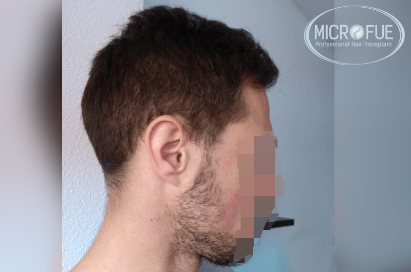 Evolución de trasplante de pelo en entradas Evolución de trasplante de pelo en entradas