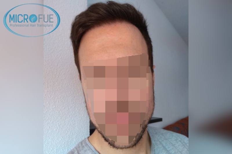 Evolución de trasplante de pelo en entradas Evolución de trasplante de pelo en entradas