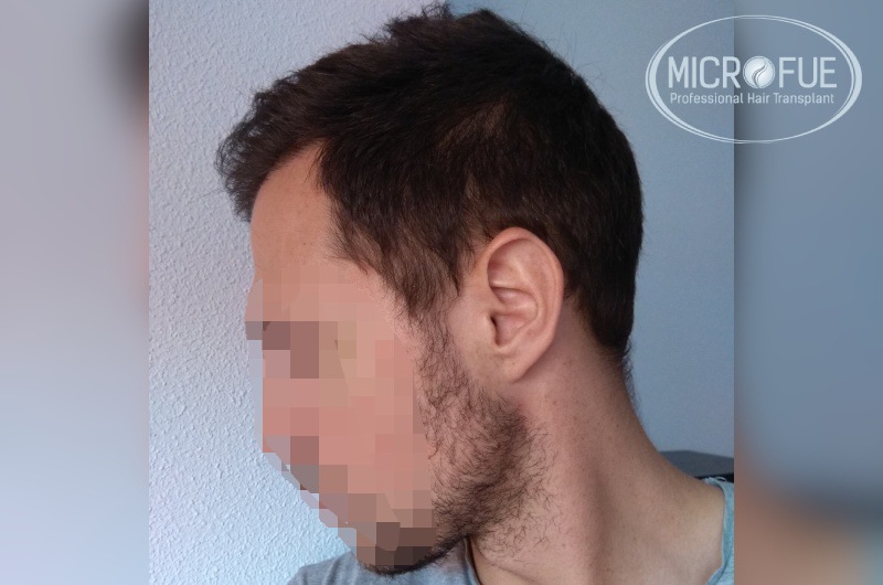 Evolución de trasplante de pelo en entradas Evolución de trasplante de pelo en entradas