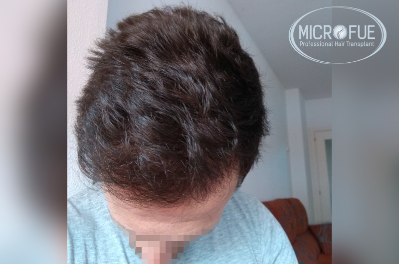 Evolución de trasplante de pelo en entradas Evolución de trasplante de pelo en entradas
