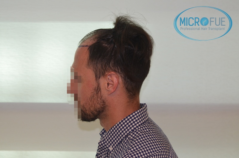 Evolución de trasplante de pelo en entradas Evolución de trasplante de pelo en entradas