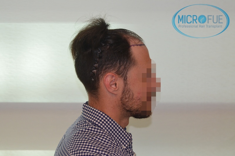 Evolución de trasplante de pelo en entradas Evolución de trasplante de pelo en entradas