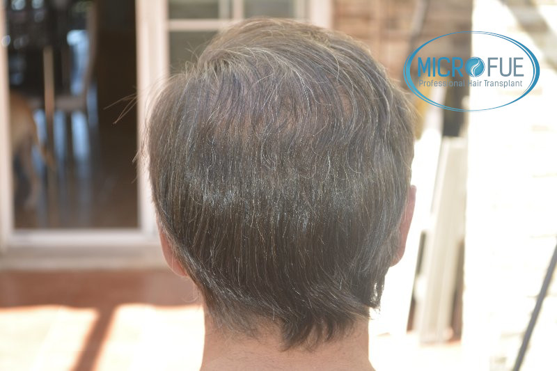 Trasplante capilar - Pacientes de microfue Trasplante capilar - Pacientes de microfue