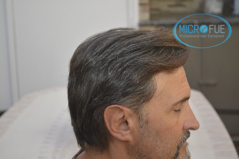 Trasplante capilar - Pacientes de microfue Trasplante capilar - Pacientes de microfue