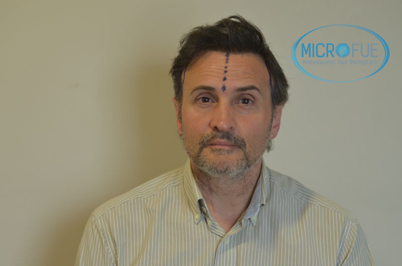 Trasplante capilar - Pacientes de microfue Trasplante capilar - Pacientes de microfue