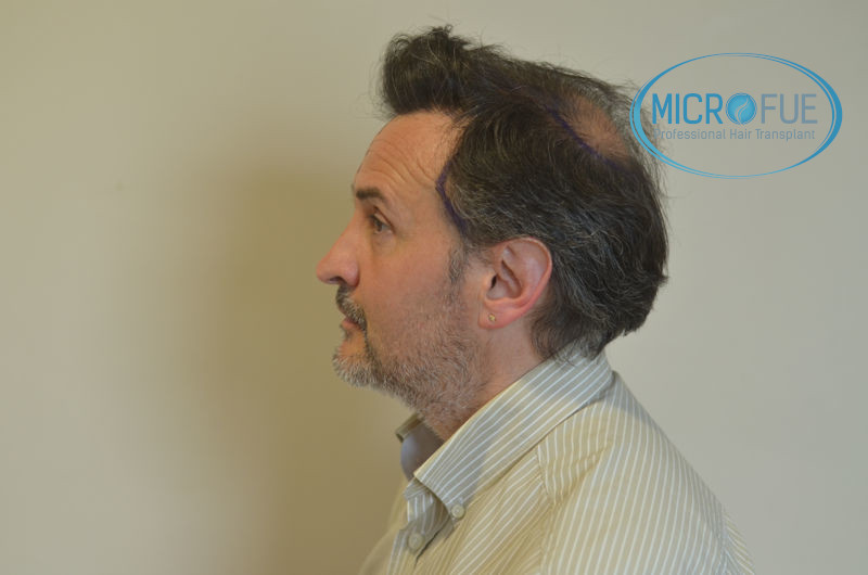 Trasplante capilar - Pacientes de microfue Trasplante capilar - Pacientes de microfue