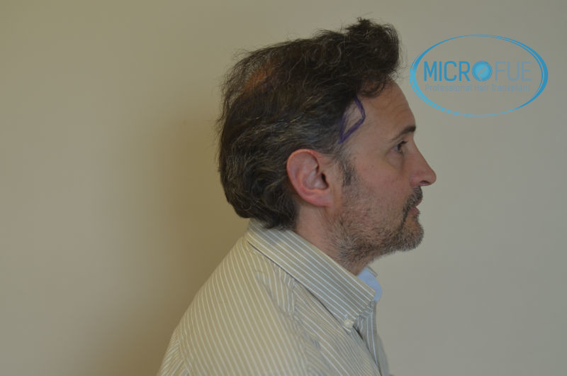 Trasplante capilar - Pacientes de microfue Trasplante capilar - Pacientes de microfue