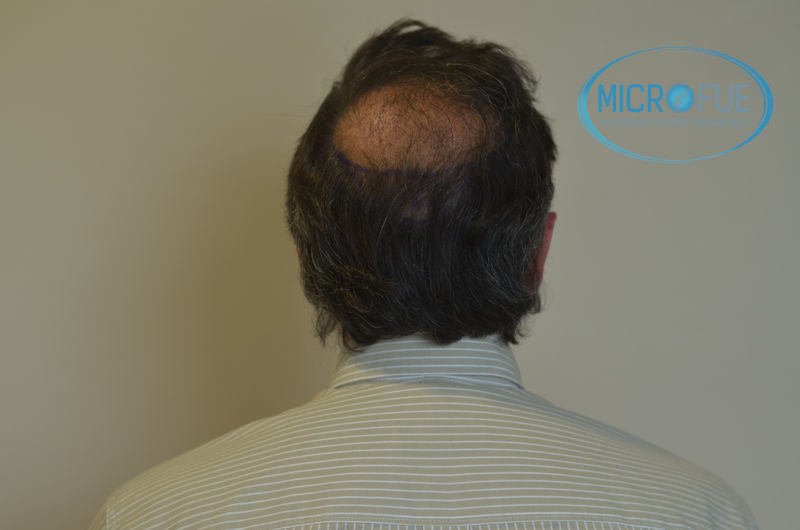 Trasplante capilar - Pacientes de microfue Trasplante capilar - Pacientes de microfue