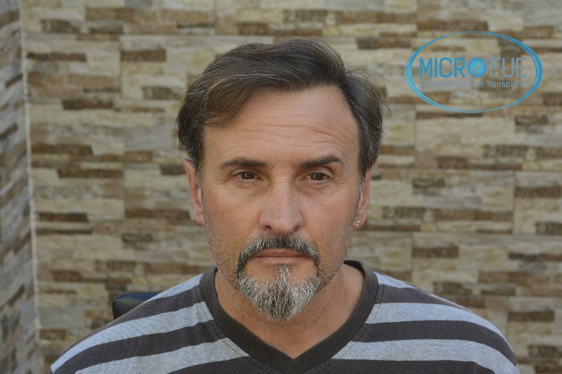 Trasplante capilar - Pacientes de microfue Trasplante capilar - Pacientes de microfue