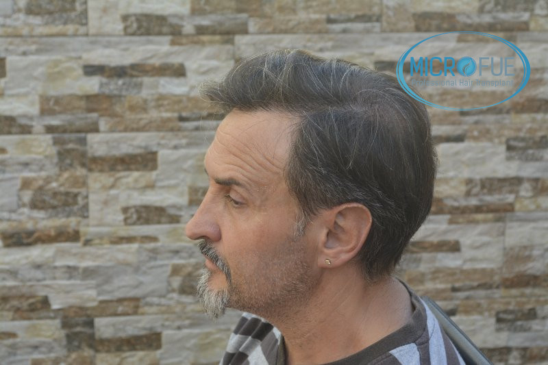 Trasplante capilar - Pacientes de microfue Trasplante capilar - Pacientes de microfue