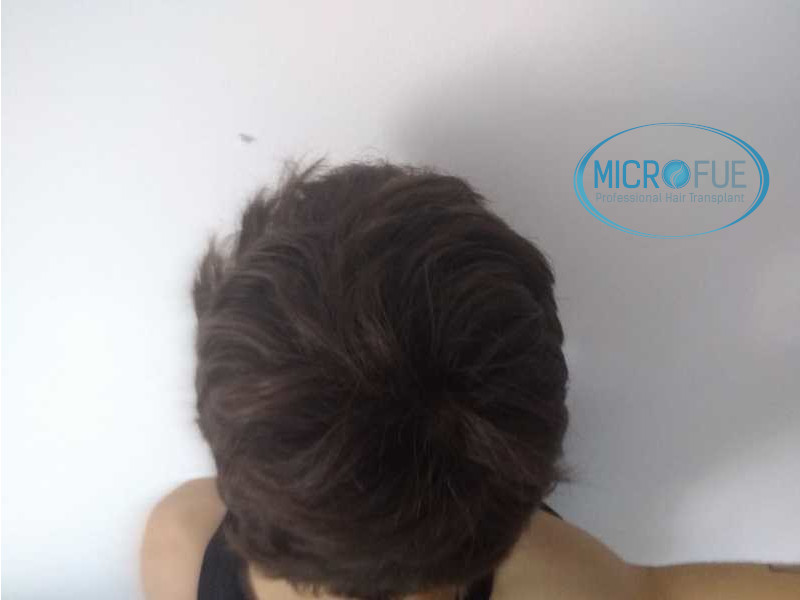 Evolución de trasplante de pelo, comparación antes y después Evolución de trasplante de pelo, comparación antes y después