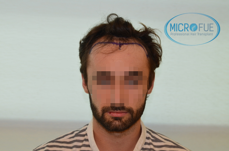 Evolución de trasplante de pelo, comparación antes y después Evolución de trasplante de pelo, comparación antes y después