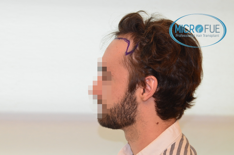Evolución de trasplante de pelo, comparación antes y después Evolución de trasplante de pelo, comparación antes y después