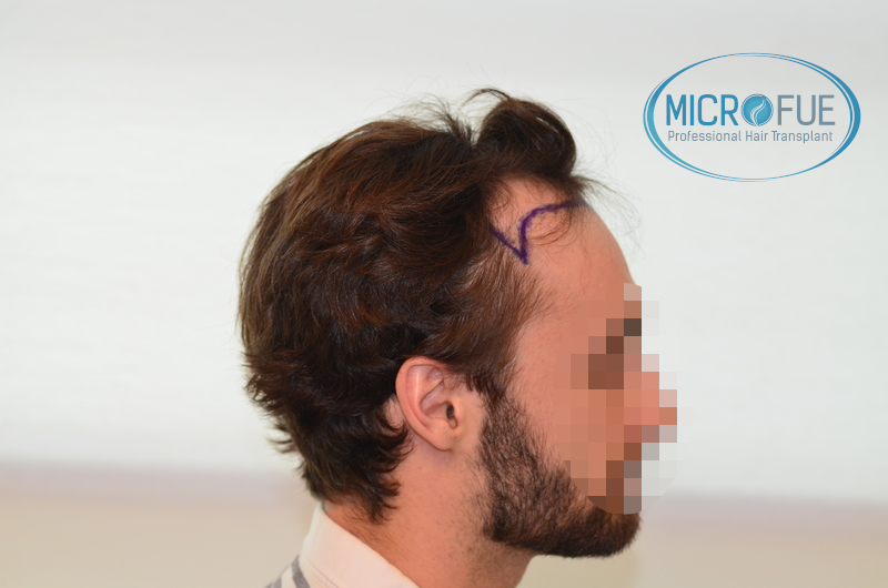 Evolución de trasplante de pelo, comparación antes y después Evolución de trasplante de pelo, comparación antes y después