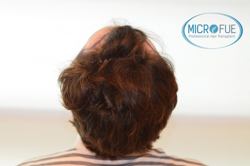 Evolución de trasplante de pelo, comparación antes y después Evolución de trasplante de pelo, comparación antes y después