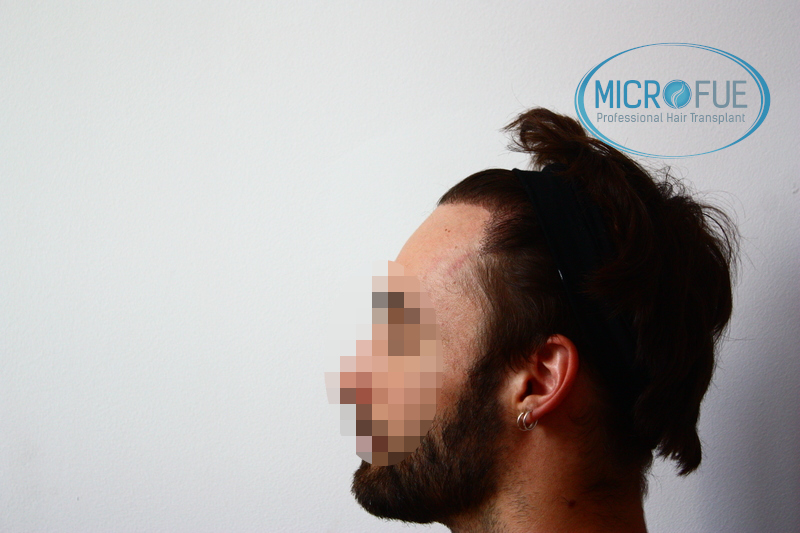Evolución de trasplante de pelo, comparación antes y después Evolución de trasplante de pelo, comparación antes y después