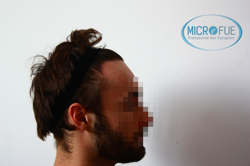 Evolución de trasplante de pelo, comparación antes y después Evolución de trasplante de pelo, comparación antes y después