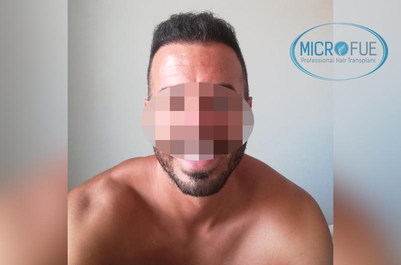 Trasplante de pelo - Evolución después de 9 meses Trasplante de pelo - Evolución después de 9 meses
