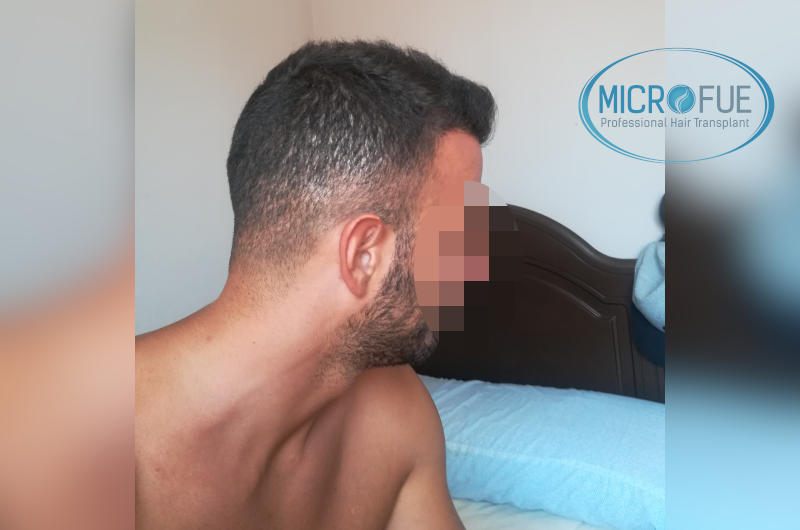 Trasplante de pelo - Evolución después de 9 meses Trasplante de pelo - Evolución después de 9 meses