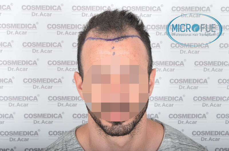 Trasplante de pelo - Evolución después de 9 meses Trasplante de pelo - Evolución después de 9 meses