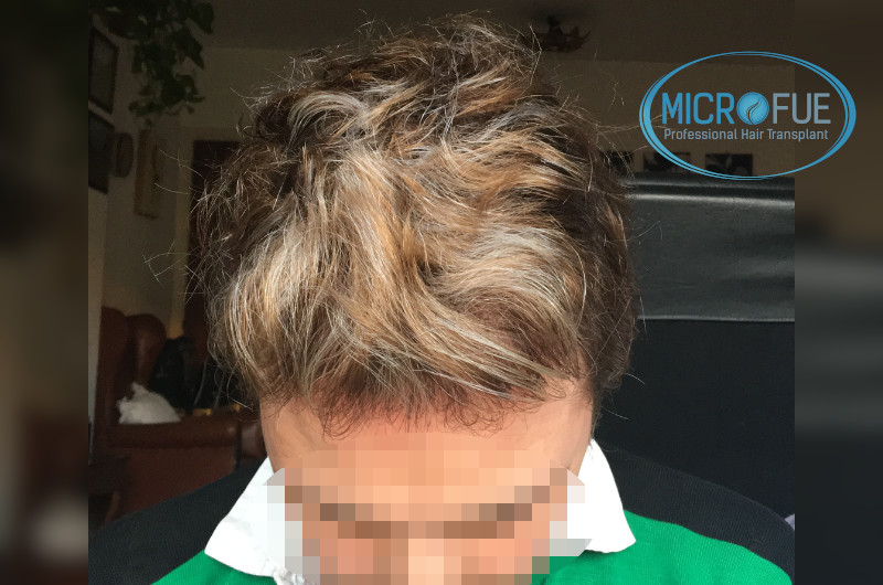 foto trasplante pelo turquía resultados antes despues foto trasplante pelo turquía resultados antes despues