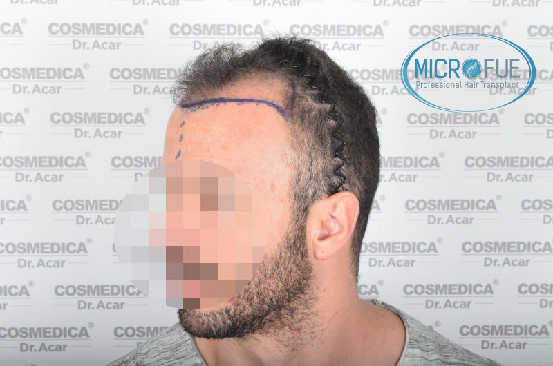 Trasplante de pelo - Evolución después de 9 meses Trasplante de pelo - Evolución después de 9 meses