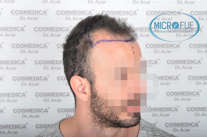 Trasplante de pelo - Evolución después de 9 meses Trasplante de pelo - Evolución después de 9 meses