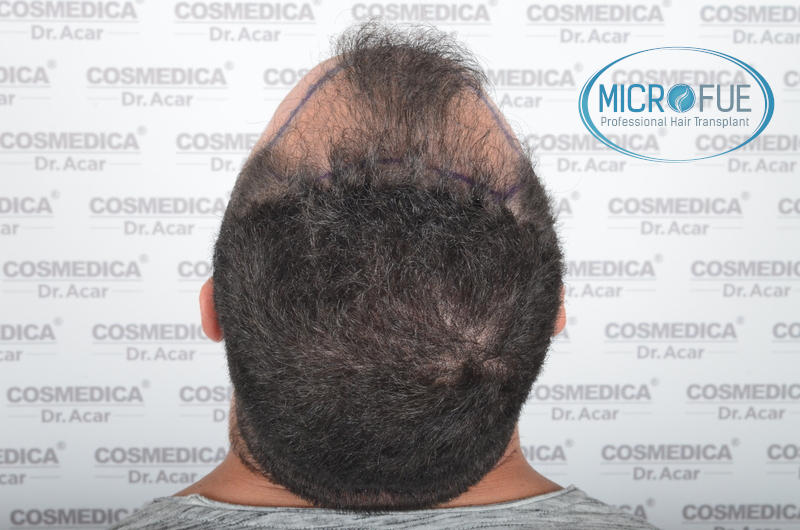 Trasplante de pelo - Evolución después de 9 meses Trasplante de pelo - Evolución después de 9 meses