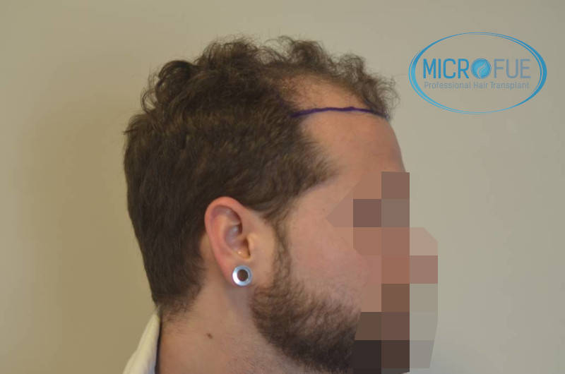microfue antes de la operación microfue antes de la operación