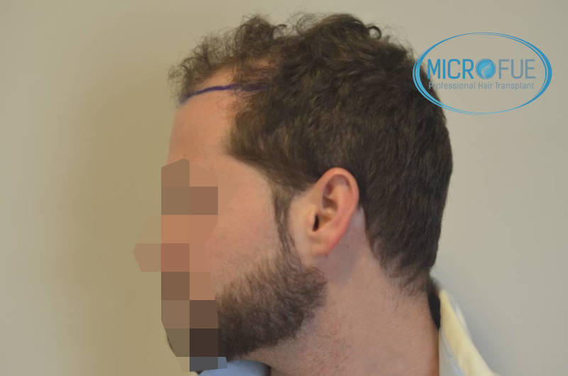 microfue antes de la operación microfue antes de la operación