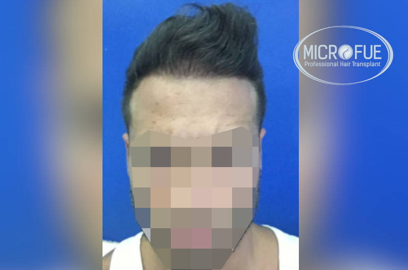 resultados con microfue después de 12 meses resultados con microfue después de 12 meses