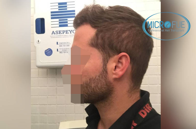resultados con microfue después de 6 meses resultados con microfue después de 6 meses