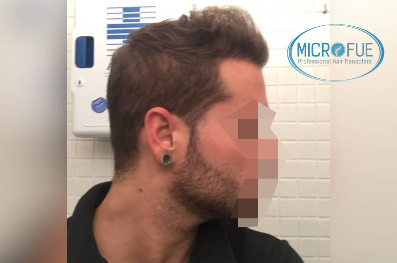 resultados con microfue después de 6 meses resultados con microfue después de 6 meses