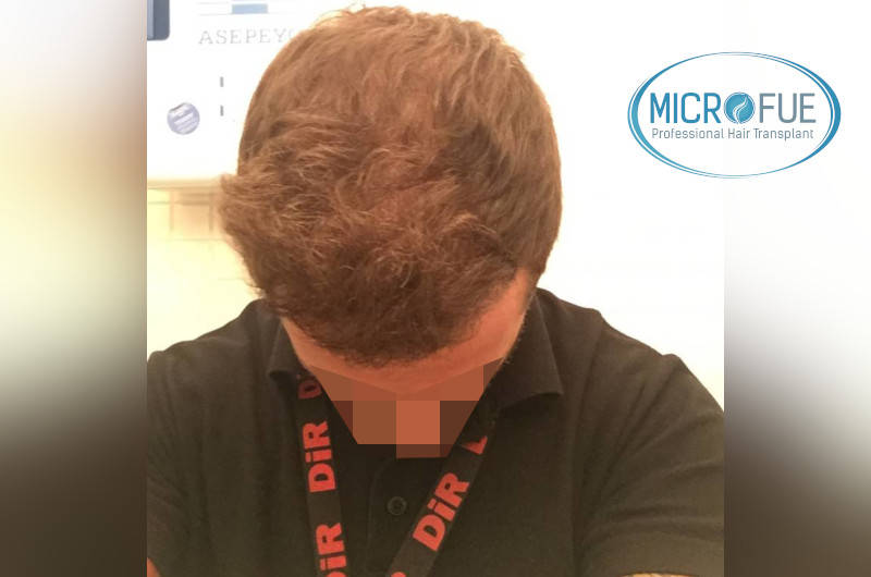 resultados con microfue después de 6 meses resultados con microfue después de 6 meses