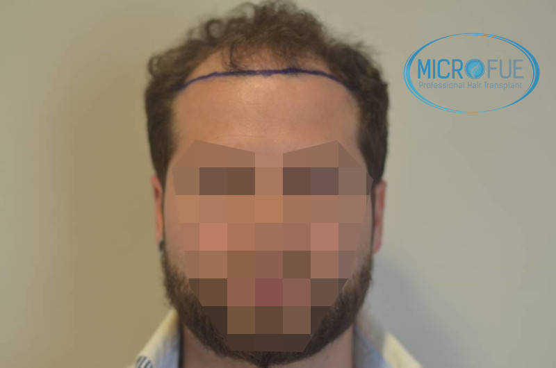 microfue antes de la operación microfue antes de la operación