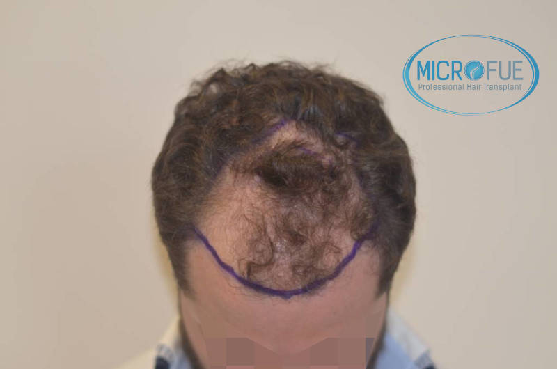 microfue antes de la operación microfue antes de la operación