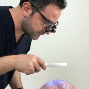 por que ir a turquia para trasplante de pelo