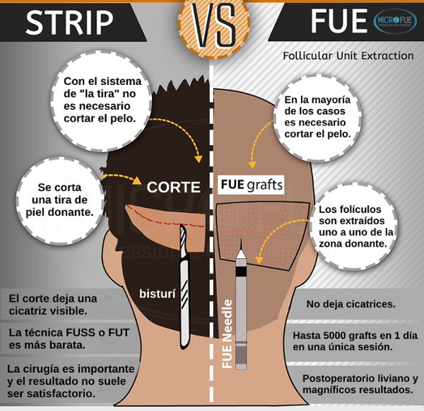 ventajas técnica FUE sobre la FUSS o FUT