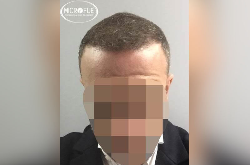 Resultados antes y despues de trasplante de pelo en turquia Resultados antes y despues de trasplante de pelo en turquia