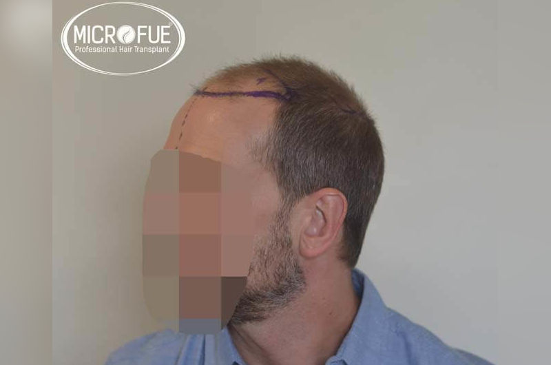 Resultados antes y despues de injerto de pelo en turquia Resultados antes y despues de injerto de pelo en turquia