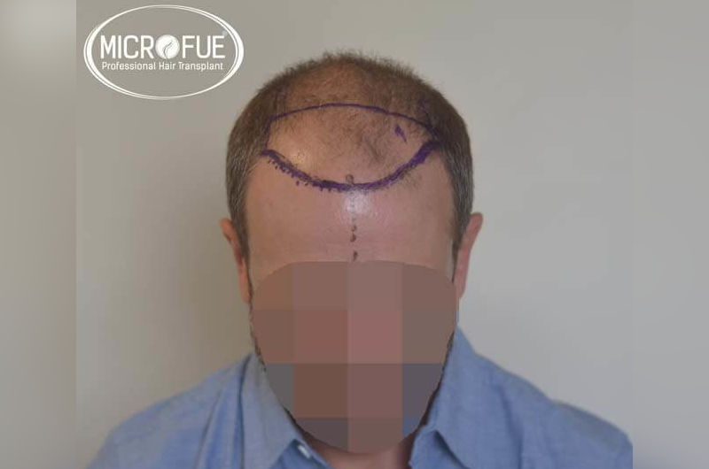Resultados antes y despues de microinjerto de pelo en turquia Resultados antes y despues de microinjerto de pelo en turquia