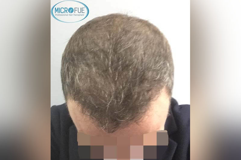 Resultados antes y despues de injerto de pelo en turquia Resultados antes y despues de injerto de pelo en turquia