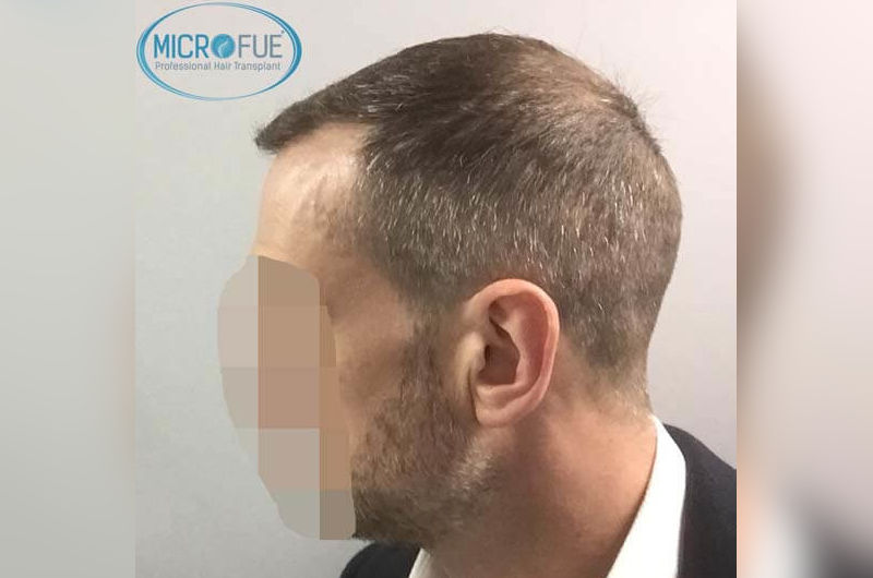 Resultados antes y despues de microinjerto capilar en turquia Resultados antes y despues de microinjerto capilar en turquia