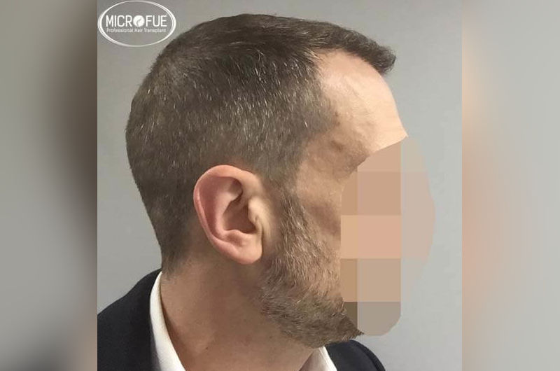 Resultados antes y despues de microinjertoe de pelo en turquia Resultados antes y despues de microinjertoe de pelo en turquia