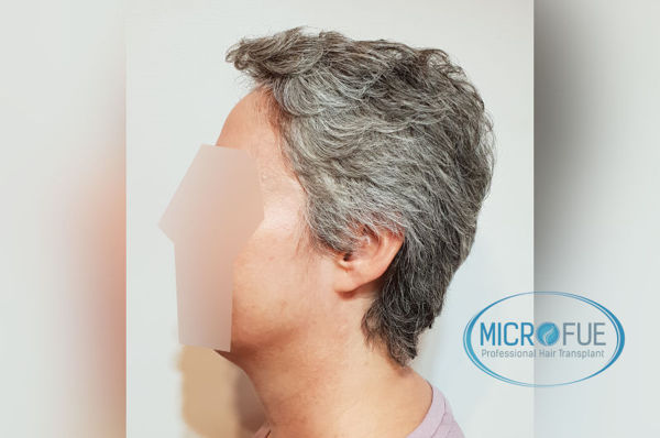 Trasplante capilar en mujeres - Antes y después Trasplante capilar en mujeres - Antes y después