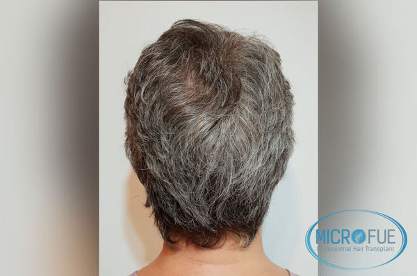 Trasplante capilar en mujeres - Antes y después Trasplante capilar en mujeres - Antes y después