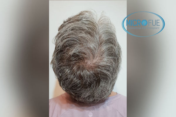 Trasplante capilar en mujeres - Antes y después Trasplante capilar en mujeres - Antes y después