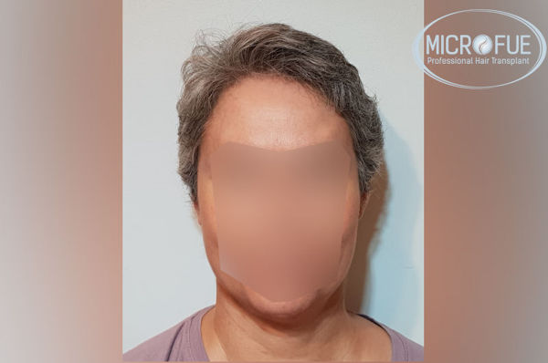 Trasplante capilar en mujeres - Antes y después Trasplante capilar en mujeres - Antes y después
