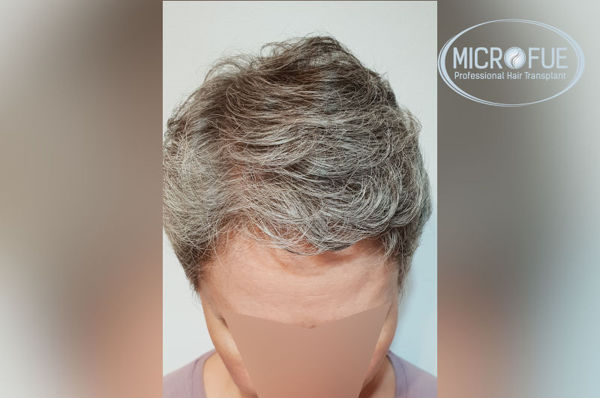 Trasplante capilar en mujeres - Antes y después Trasplante capilar en mujeres - Antes y después
